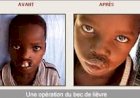 Ils  ont retrouvé leurs lèvres grâce à la Fondation Gerico