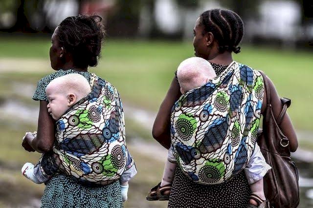 Goma: la menace du trafic d'organe des albinos persiste