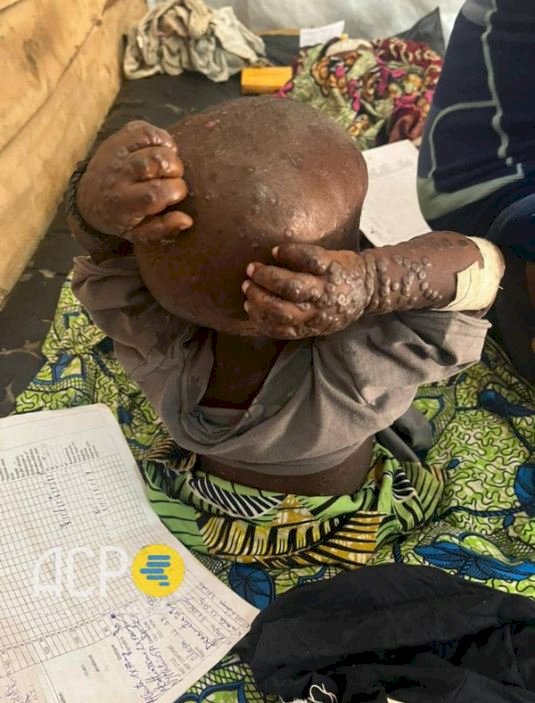 RDC : « Sans un soutien urgent, l’épidémie de monkeypox pourrait devenir dévastatrice pour les réfugiés et les déplacés internes » (HCR)